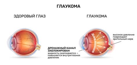 Туман в глазах — почему мутнеет в глазах, причины, что делать