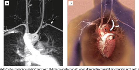 Figure 2 From A Right Sided Aortic Arch With Kommerells Diverticulum