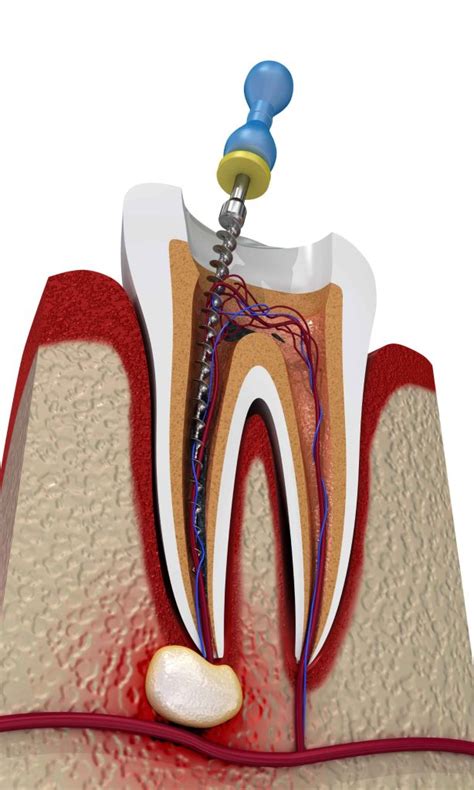 Tratamiento De Conducto Dental Hot Sex Picture