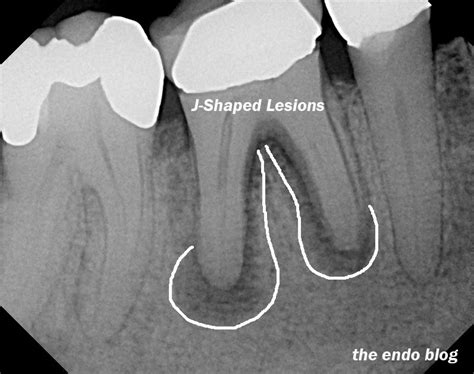 The Endo Blog Diagnosing Root Fractures