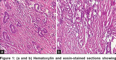 Figure 1 From Role Of Fibrotic Cancer Stroma In Rectal Carcinoma An