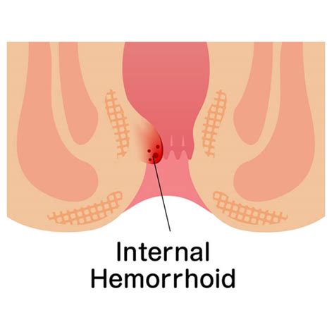 Hemorrhoids Symptoms Female Gelatinspa