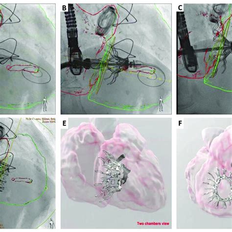 Lux Valve Plus Case Pre Procedural Transthoracic And Transesophageal Download Scientific