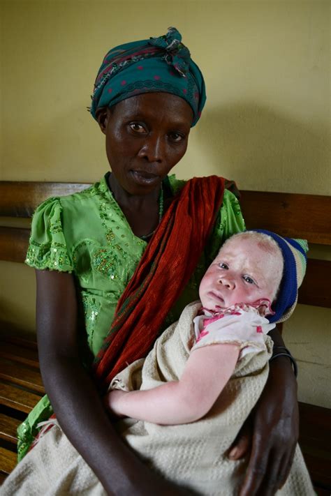 Living With Albinism In Uganda Dana Ullman