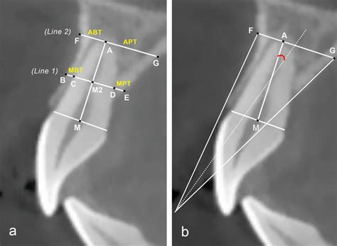 A Measurements Of Bone Thickness At Different Aspects B Measuring