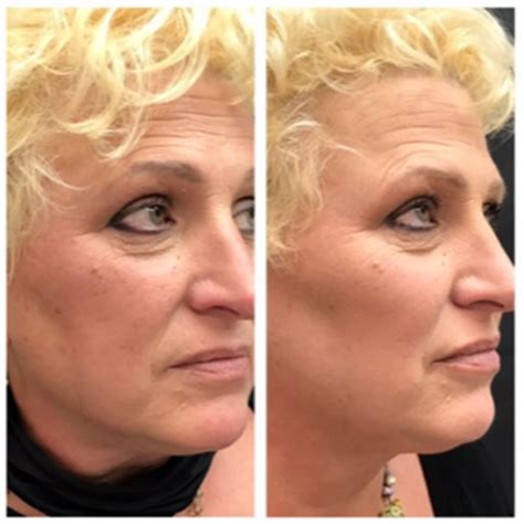 Vivi Nonsurgical Facelift Revivify Medical Spa Contact Us Today