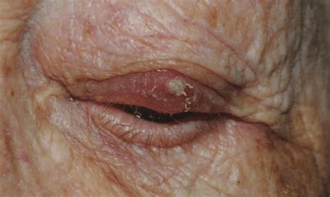 Preoperative clinical photograph showing sebaceous carcinoma of the... | Download Scientific Diagram