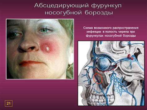 Фурункулы и карбункулы лица и шеи. Этиология, клиника,