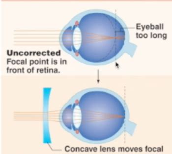 Eye Pathology Flashcards Quizlet