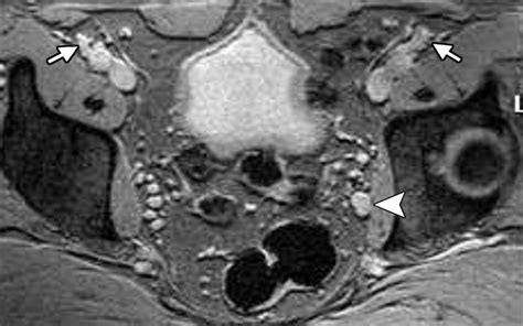 Imaging Diagnosis And Follow Up Of Advanced Prostate Cancer Clinical