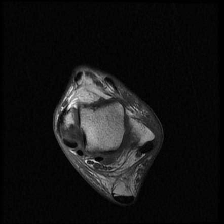 Posterior Tibial Nerve Sheath Tumor Image Radiopaedia Org