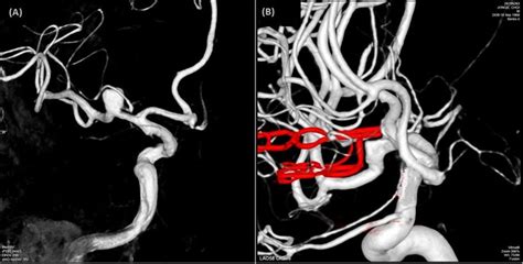 3D Rotational Angiography Taken Before And After Surgical Clipping A