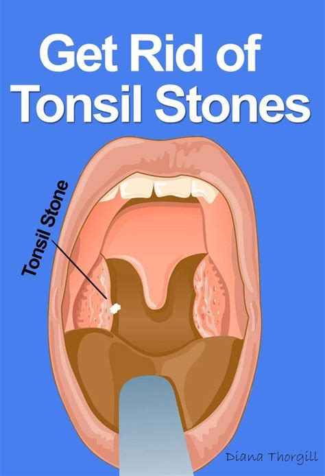 Get Rid Of Tonsil Stones Causes Symptoms Treatment Removal And