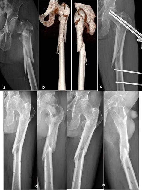 A 77 Year Old Male Ao Type 31 A33 Apre Operative Anteroposterior Download Scientific