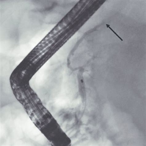 In The First Ercp The Cannula Is In The Pancreatic Duct The Duct Download Scientific Diagram