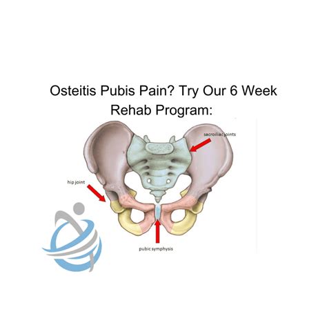 Struggling With Osteitis Pubistry This 6 Week Rehab Program