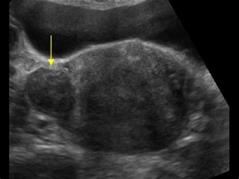 Gynaecology 31 Uterus Case 311 Uterine Fibroids Ultrasound Cases