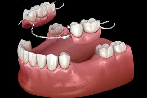 اوردنچر ثابت چیست اوردنچر ثابت با پشتیبانی ایمپلنت کلینیک شبانه