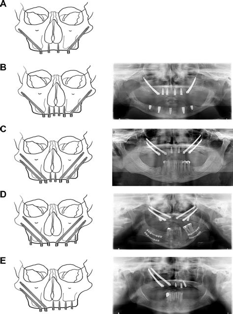 Zygomatic Implants In Combination With Dental Implants Pocket Dentistry