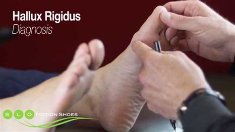 Hallux Rigidus Causes Diagnosis And Treatment Youtube