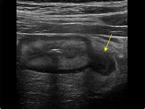 Abdomen and retroperitoneum | 1.6 Gastrointestinal tract : Case 1.6.1 Diverticulosis and ...