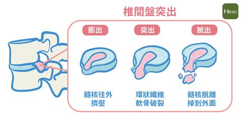 骨科名醫：腰痛多躺有道理！椎間盤突出不想開刀，臥床休息是緩解良方 蕃新聞