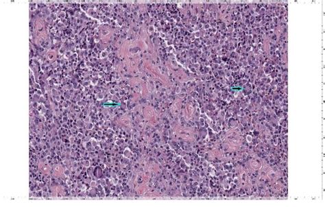 Figure 1 From Proximal Epithelioid Sarcoma Of The Vulva A Rare