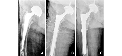 A Radiographs Of Year Old Woman With Vancouver Type B