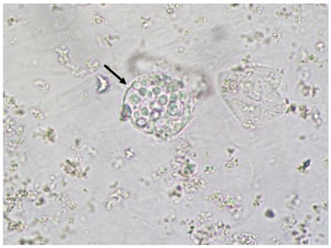 Jof Free Full Text Urine Sediment Findings And The Immune Response