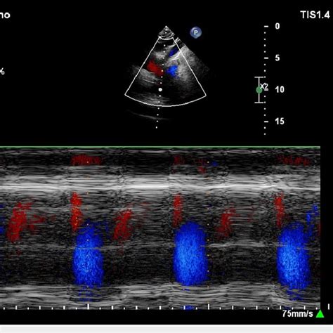 Continuous Wave Doppler Across The Aortic Valve Showing An Aortic