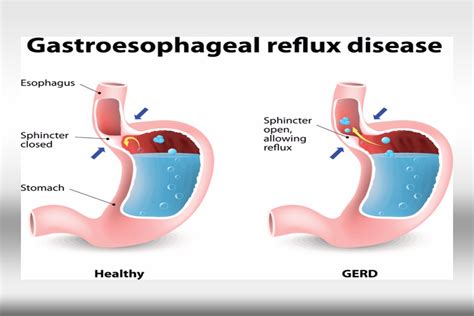 Mcclures Choice Gastroesophageal Reflux Disease Mcc Internal Medicine