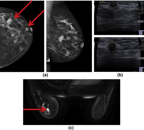 Mri Guided Breast Biopsy A Review Of Technique Indications And Radiologicalpathological