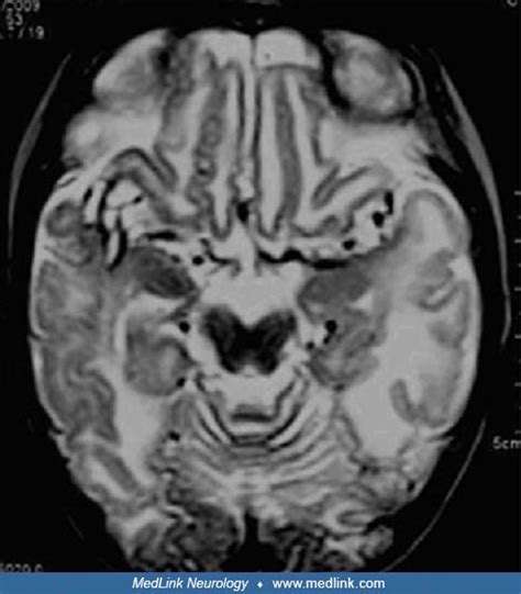 Menkes Disease X Rays