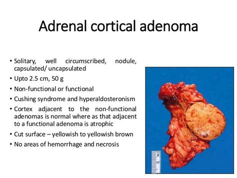 Adrenal Gland Diseases And Tumors