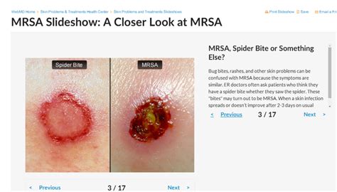 Spider Bite Vs Mrsa