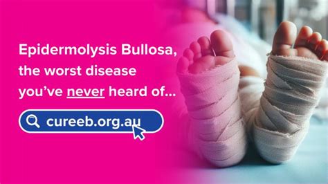 Cure Eb Epidermolysis Bullosa Sydney