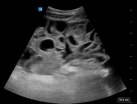 Ovarian Hyperstimulation Syndrome Meded Cases