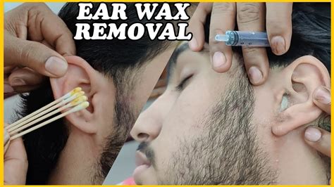 Nasty Ear Cleaning And Wax Removal With Hydrogen Peroxide By Reiki Master💈asmr Youtube