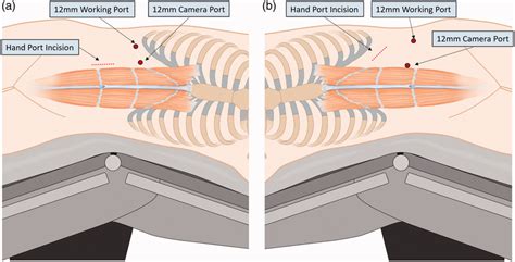 Hand Port Placement And Trocar Sites For Hand Assisted Laparoscopic