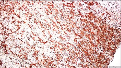 Positive Staining Of Sex Cord Stromal Cells By Immunohistochemical