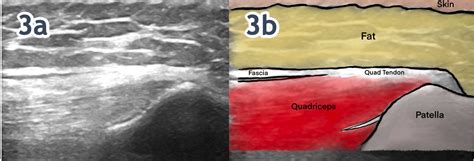 The Use Of MSK Ultrasound With Quadriceps Muscle Injury Published In