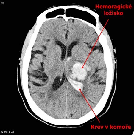 Hemoragick Cmp Ct Medic Na Nemoci Studium Na Lf Uk