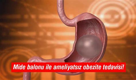 Mide Balonu Ile Ameliyats Z Obezite Tedavisi Yenig N Gazetesi