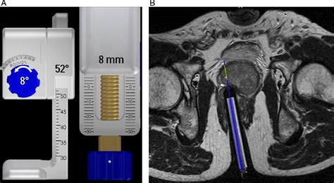 Image Guided Targeted Prostate Biopsies Techniques In Vascular And Interventional Radiology