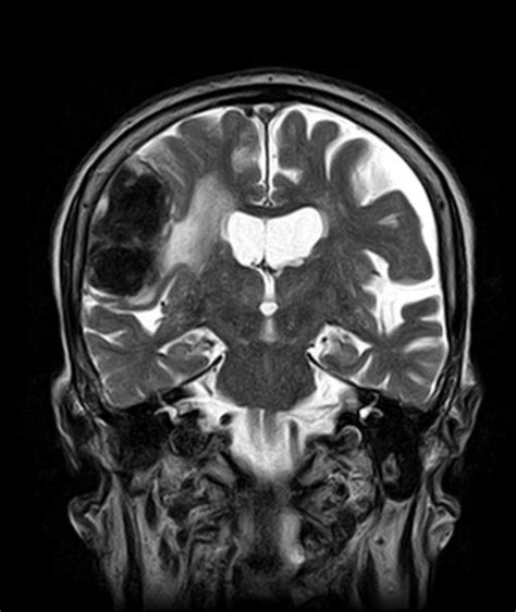 Calcified Meningioma Frontal Image Radiopaedia Org