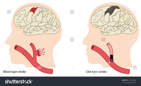 Two Causes Of Stroke, A Bleed Type Stroke And A Clot Type Stroke. Stock Vector Illustration ...