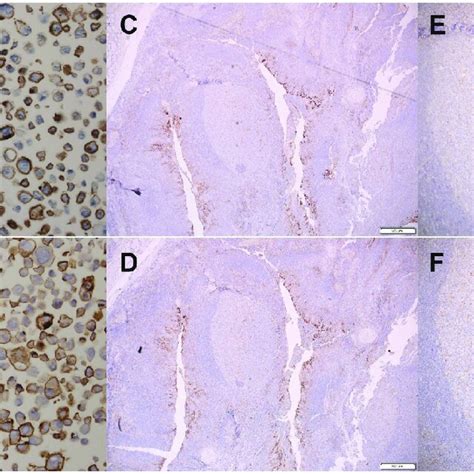 Pd L Staining Pattern Using Pd L Ihc C Pharmdx And The C