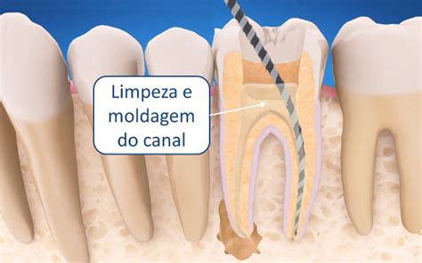 Como é Feito Canal No Dente Msk Odontologia