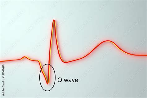 Ecg In Myocardial Infarction 3d Illustration Showing Pathological Q Wave Labeled Image Stock