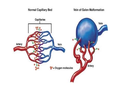 Vein of galen malformation